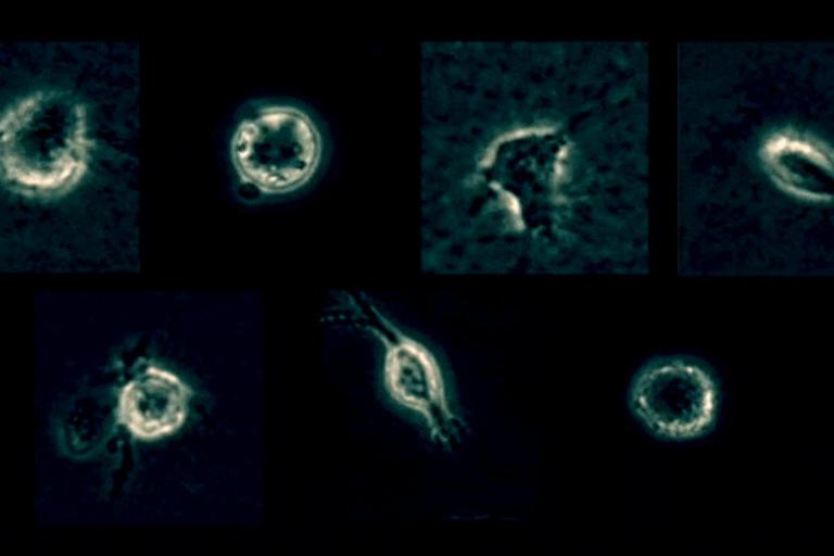 Patient-derived melanoma cells