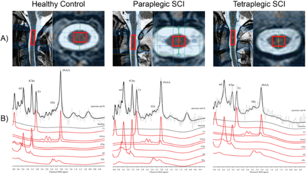 MR Spectroscopy of the Cervical Spinal Cord in Chronic Spinal Cord Injury