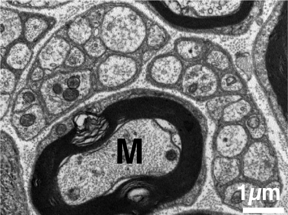 Neural-crest Stem Cells and Malignant Peripheral Nerve Sheath Tumor ...