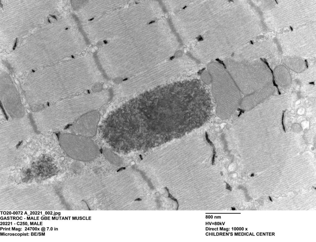 Polyglucosans (insoluble glycogen) in the muscle of a mouse model