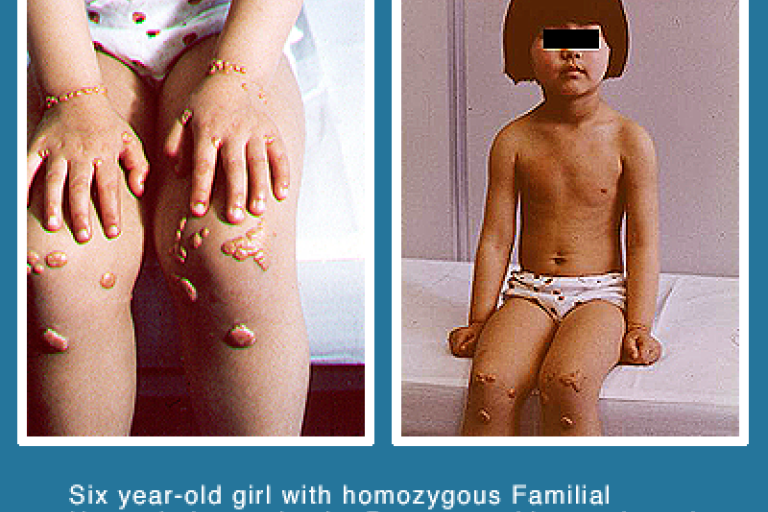 Six year old girl with homozygous familial hypercholesterolemia