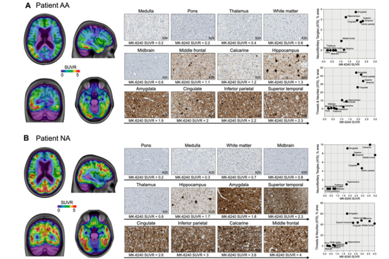 Image shows tau pathology