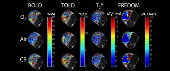 Tumor Hypoxia