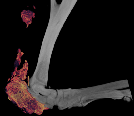 Heterotrophic Ossification