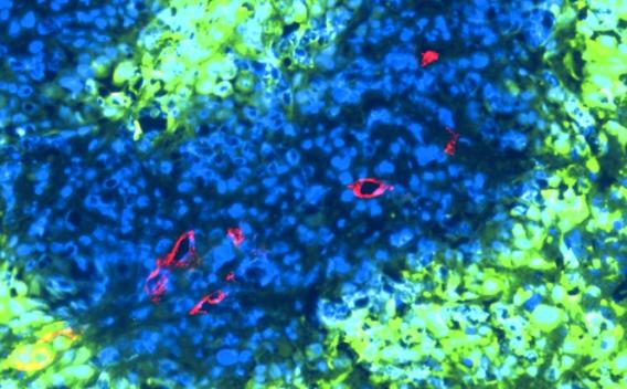 Tumor microenvironment