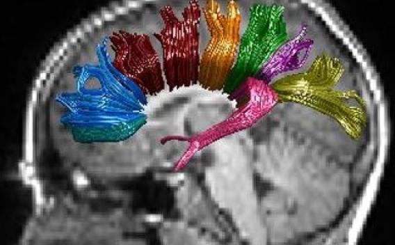 Brain scan with AFQ segmented fibers