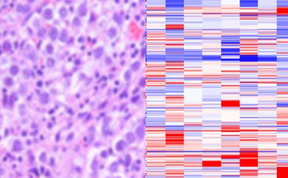 Seminoma superimposed on copy number array data