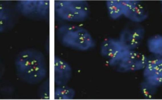 Antiestrogen resistance biopsies under microscope