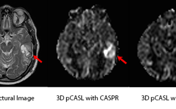 Representative cerebral blood flow (CBF) maps