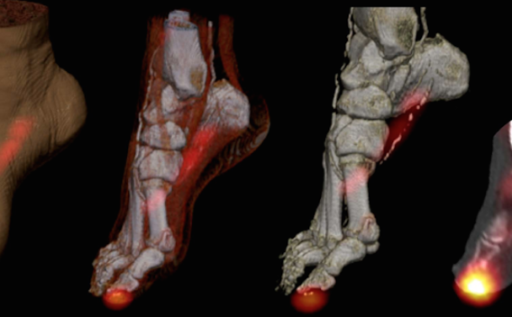 Diagnosis of diabetic foot infections using radiolabeled white blood cells