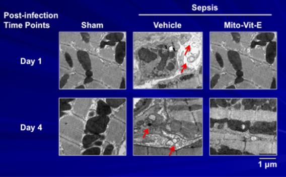 sepsis post-infection