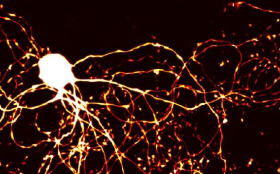 Brainstem dysfunction in Spinocerebellar Ataxia