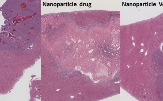 Nanomedicine Treatment of Liver Tumor comparison