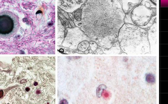 Culprits of Lafora Disease: Lafora bodies