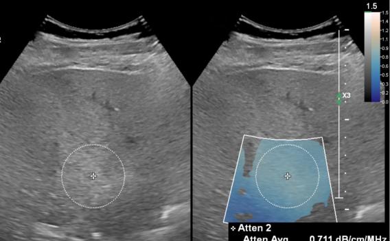 Contrast-Enhanced Ultrasound