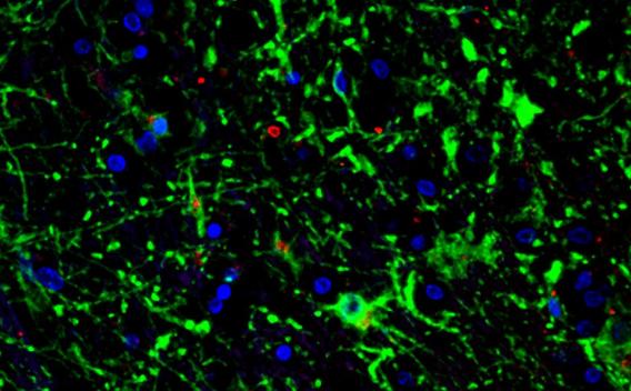 Polyglucosans (insoluble glycogen) in the brain of human patient (in red)