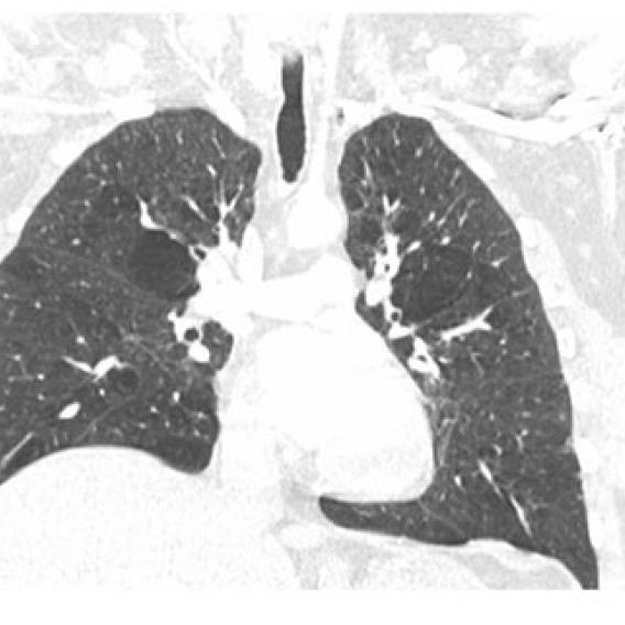 Lung X-ray