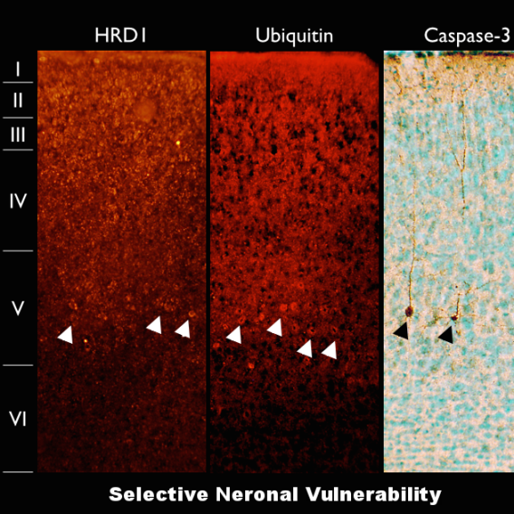 selective neuronal vulnerability