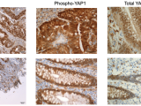 Ki67, pYAP, and tYAP staining in Colitis-Associated Cancer versus Normal Tissue