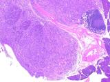 Slide of tumor microenvironment