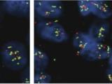 Antiestrogen resistance biopsies under microscope