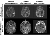 Cancer Therapy Response