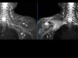 MRI Neurography using Uniform Fat/Water Separation