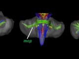 3D depiction of brainstem fibers using diffusion tensor imaging (DTI)