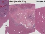 Nanomedicine Treatment of Liver Tumor comparisons
