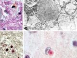 Culprits of Lafora Disease: Lafora bodies