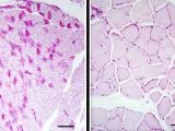 Reduction of Lafora bodies