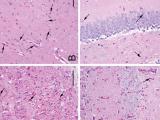 Reduction of Lafora bodies