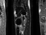 Sagittal MRI Identification of Liver Tumor comparisons
