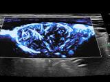 Micro-Doppler flow of kidney