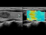 Shear Wave Imaging (comparison of 2)