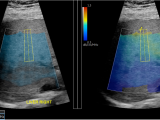 Liver Fat Quantification