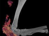 Traume induced ectopic bone growth